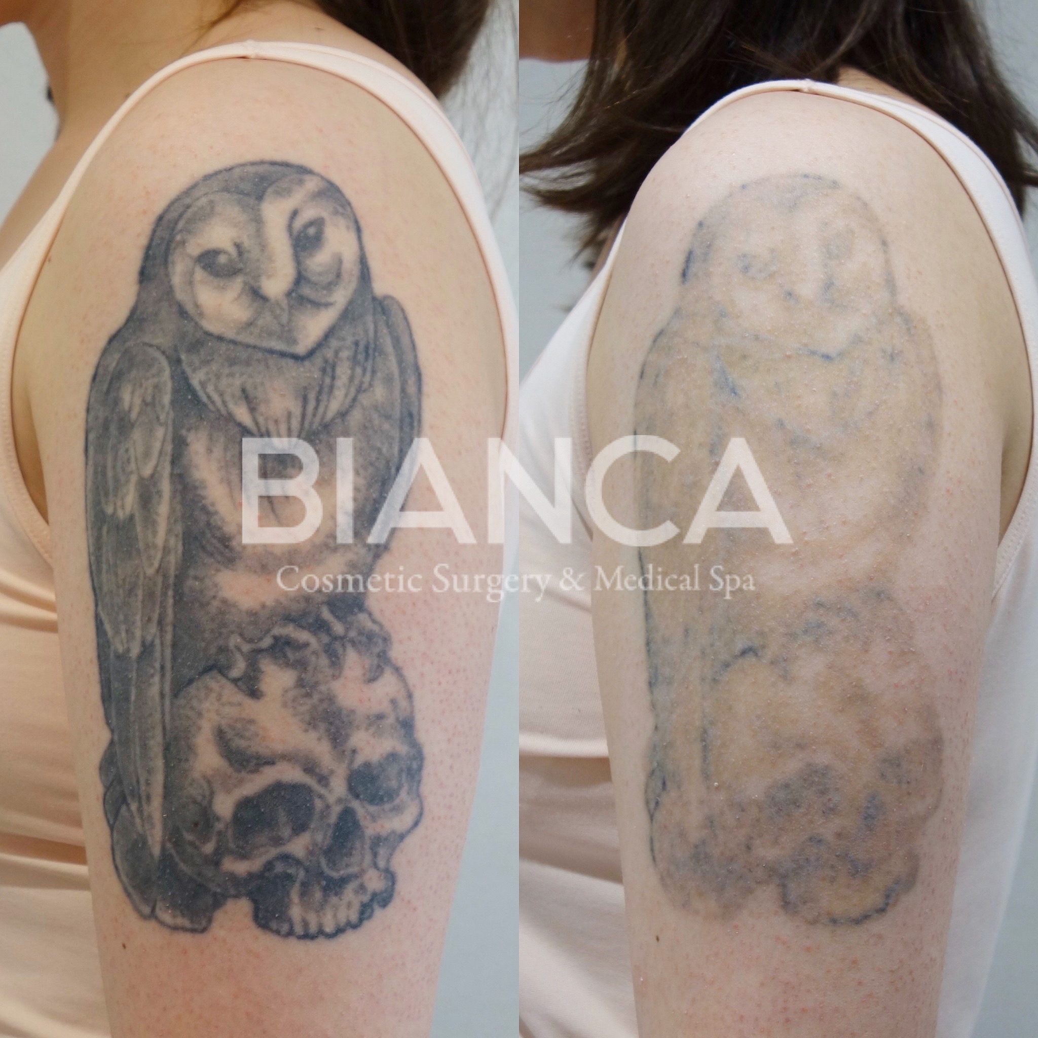 tattoo除去