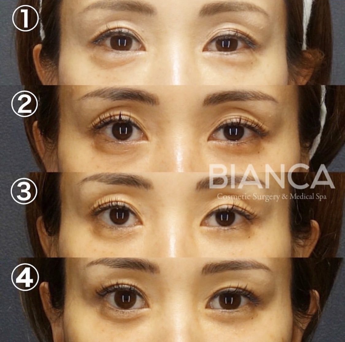 ヒアルロニダーゼ（ヒアルロン酸）✖️切らない眼瞼下垂タッキング法 ✖️目の下クマたるみ取り✖️上眼瞼ヒアルロン酸