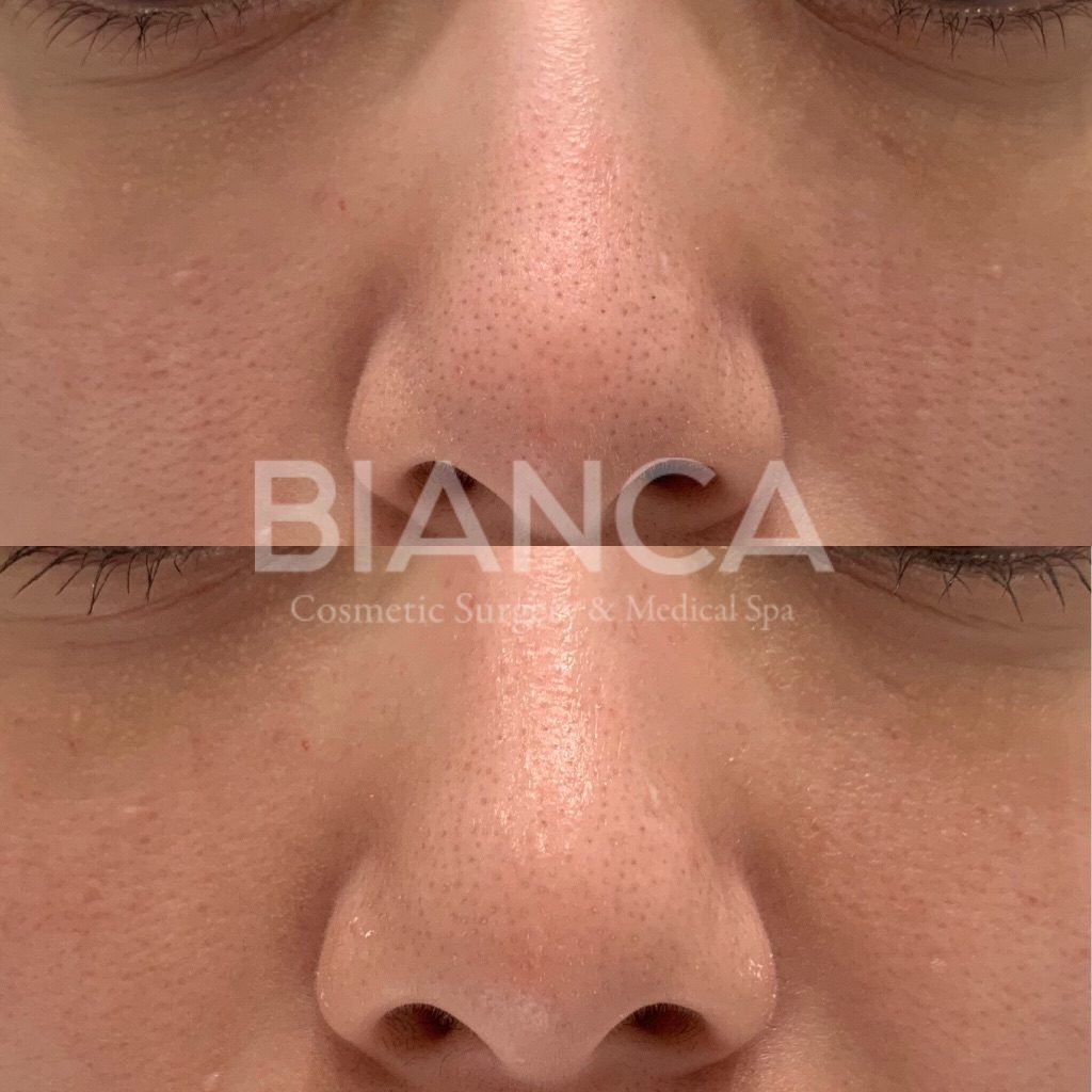Vampire Facial