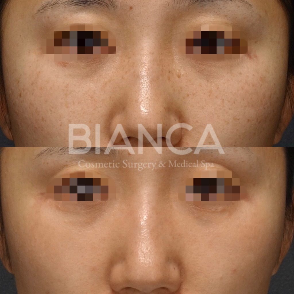Pico Spotピコトーニング (PicoSure)