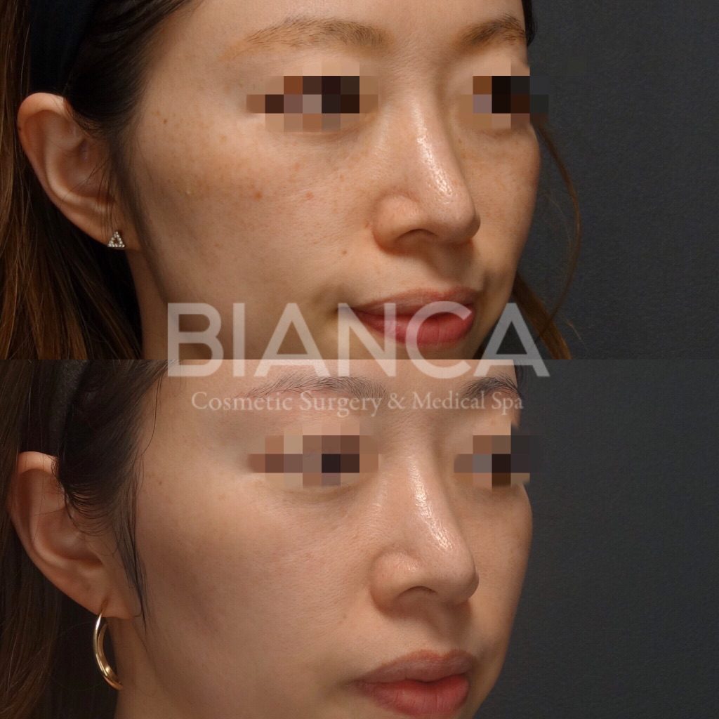 Pico Spotピコトーニング (PicoSure)