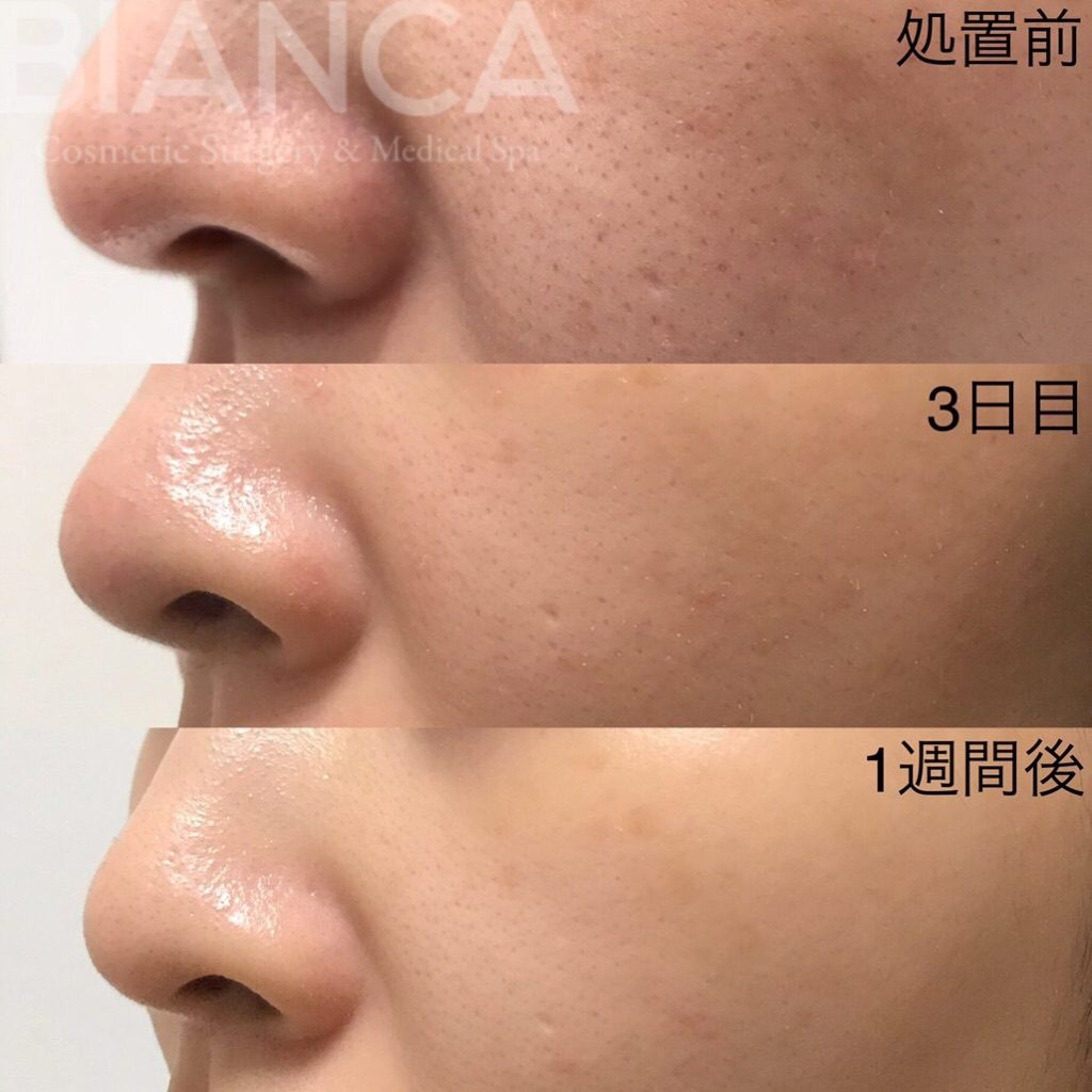 Vampire Facial