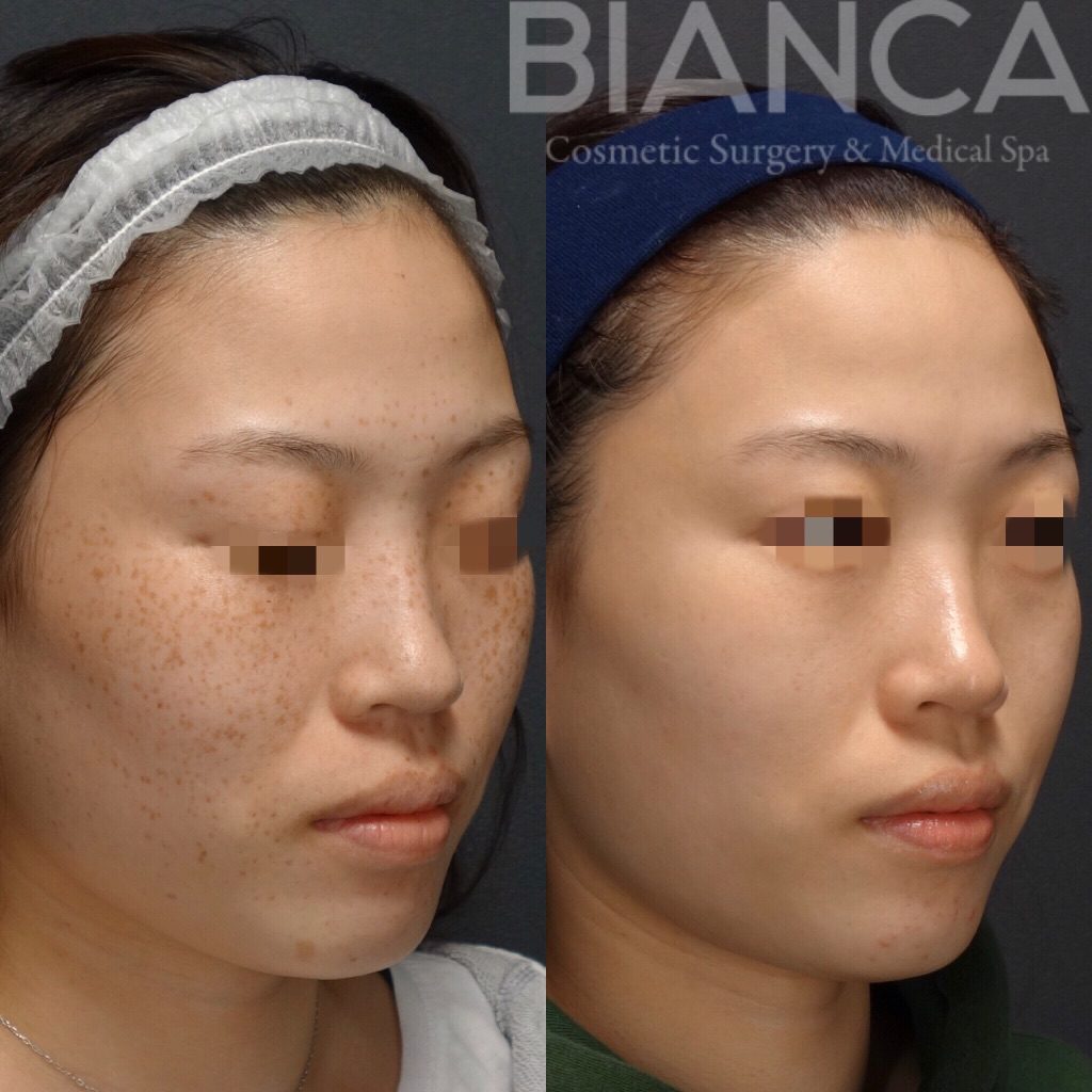 Pico Spotピコトーニング (PicoSure)