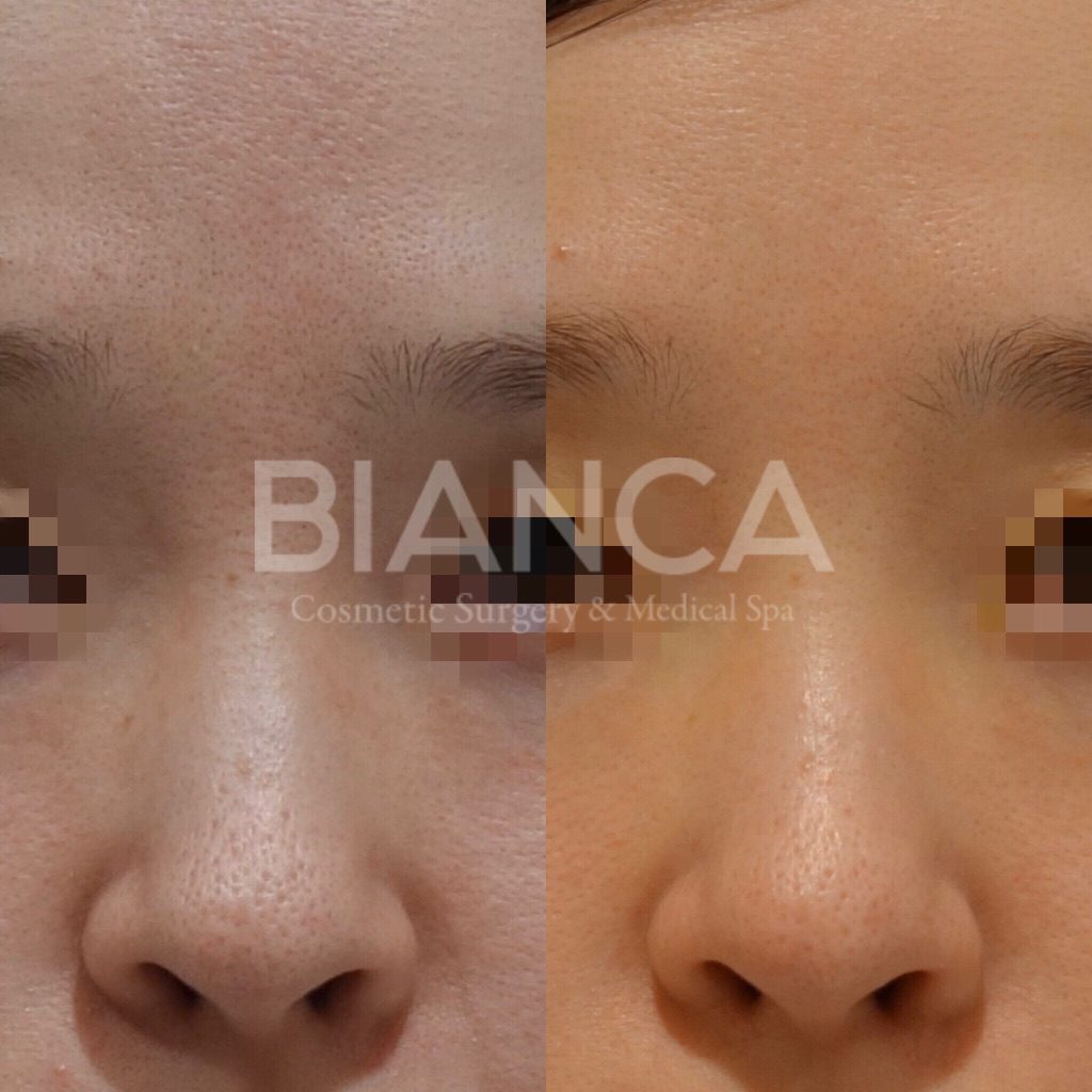 PicoSure✖️HydraFacial