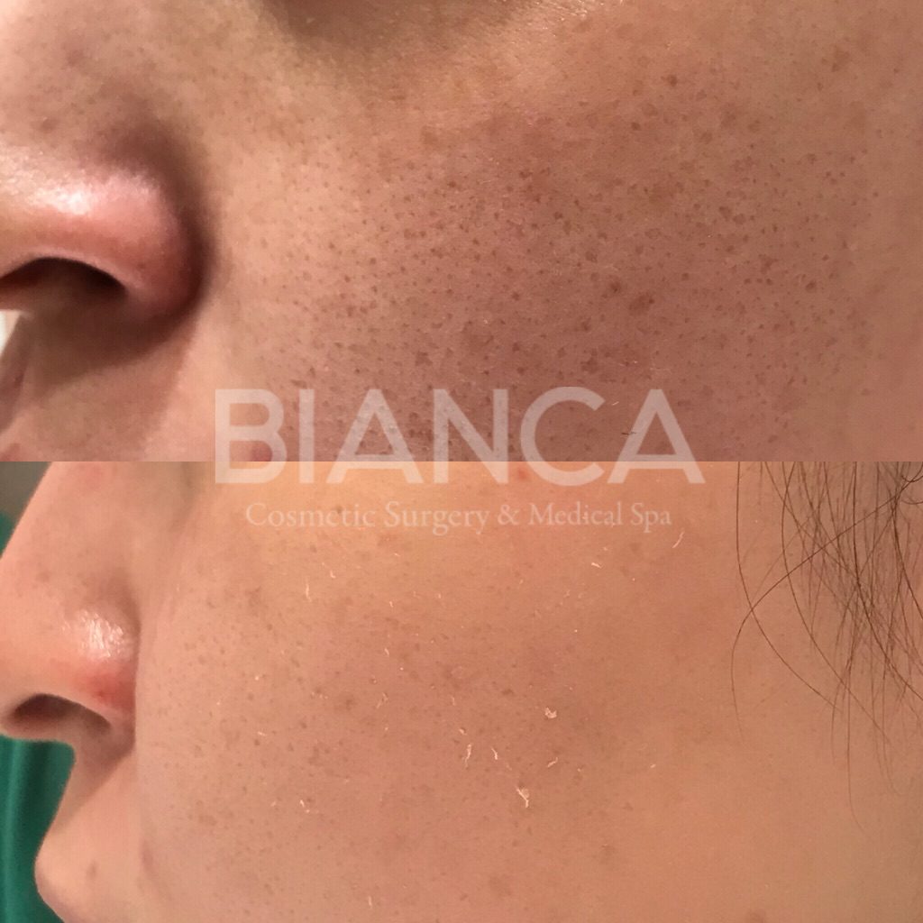 Vampire Facial