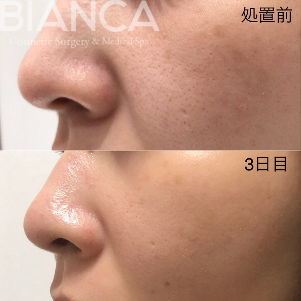 Vampire Facial