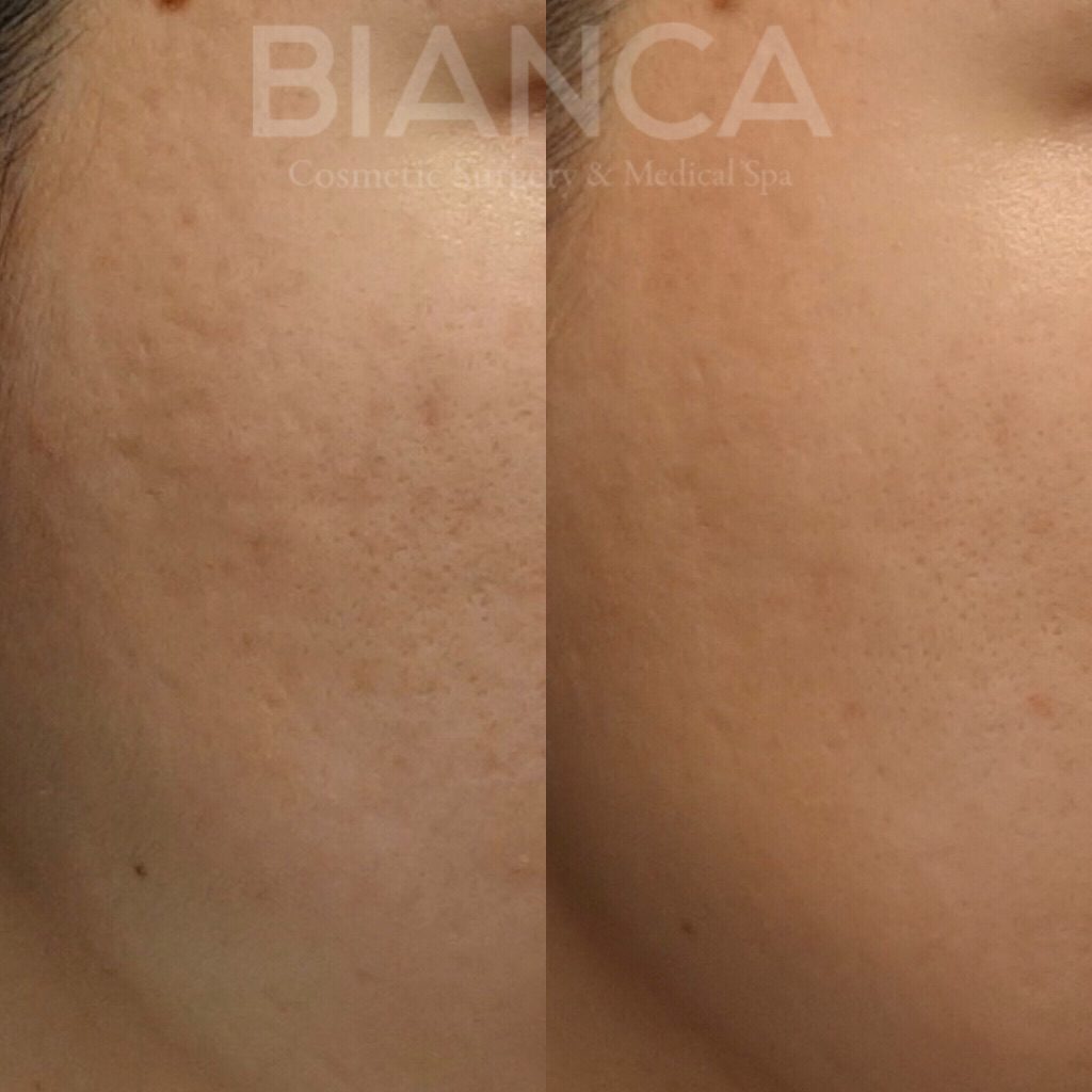 PicoSure✖️HydraFacial