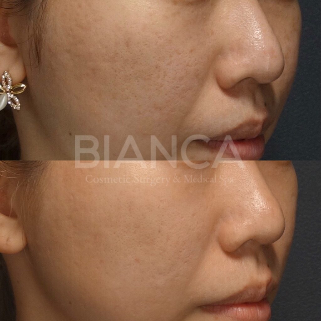 PicoSure✖️HydraFacial