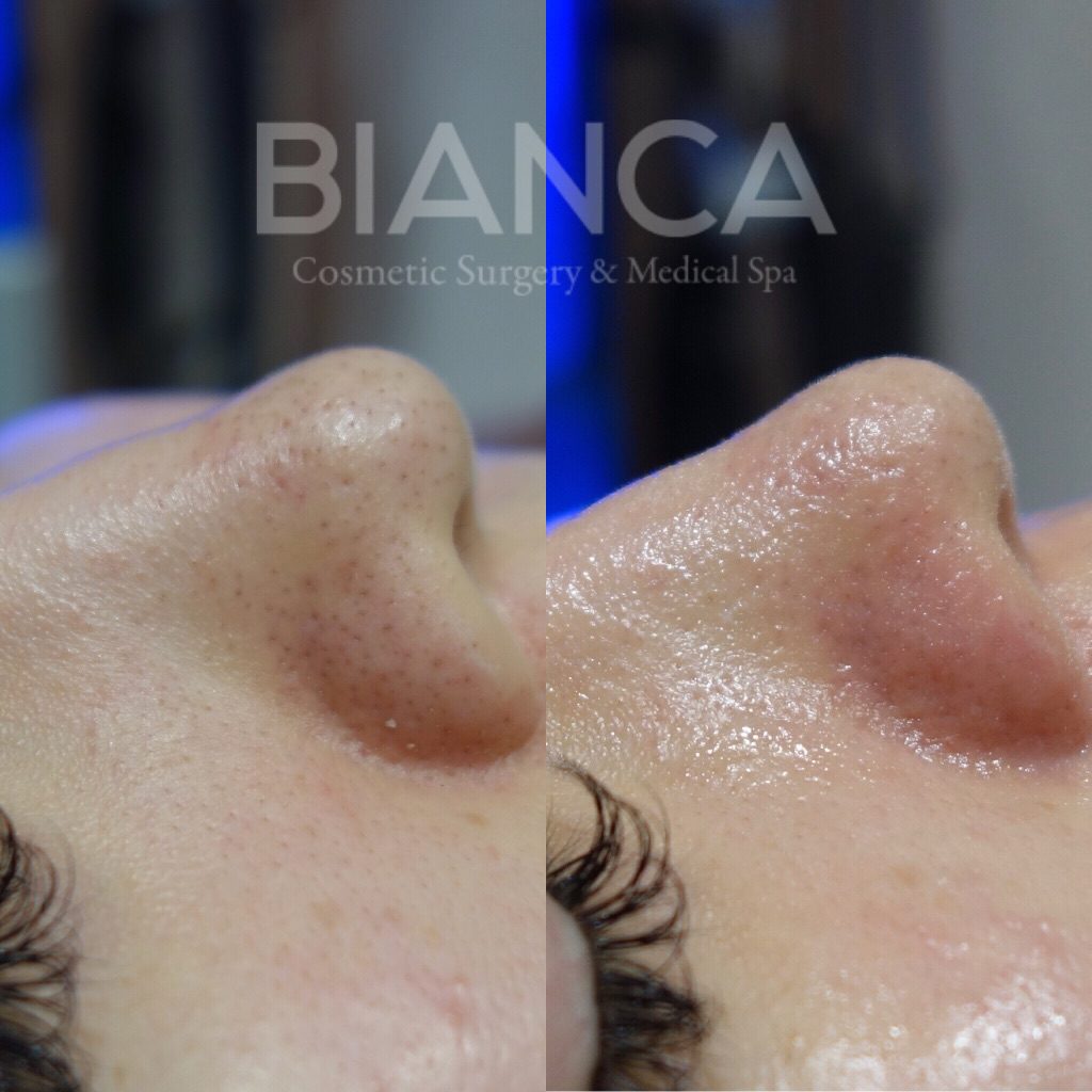 HydraFacial