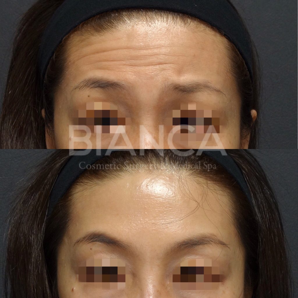 BOTOX