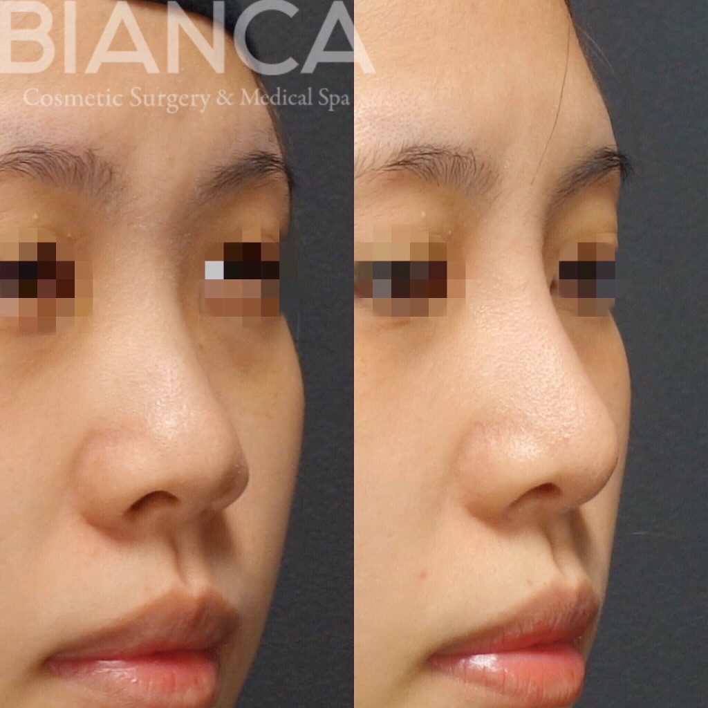 鼻プロテーゼ✖️鼻尖形成✖️耳介軟骨移植 ✖️鼻翼縮小