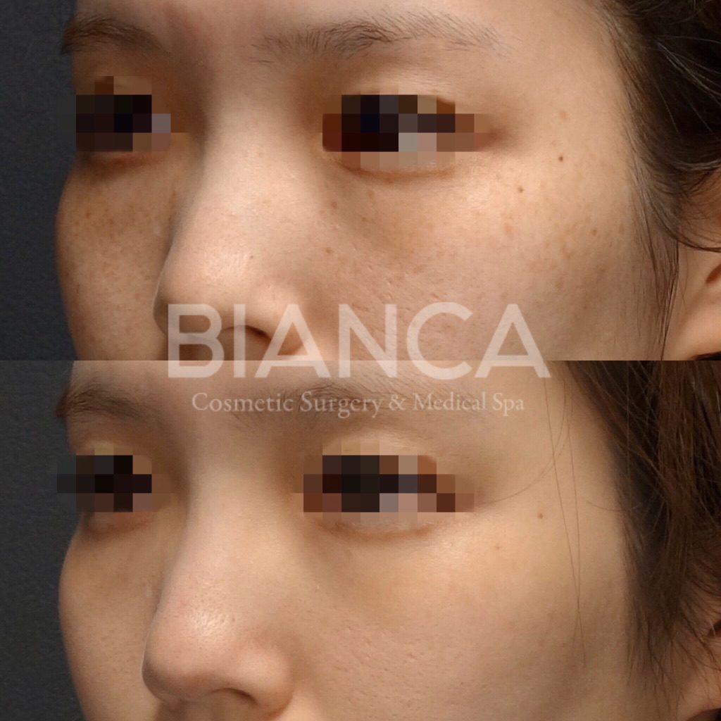 Pico Spotピコトーニング (PicoSure)