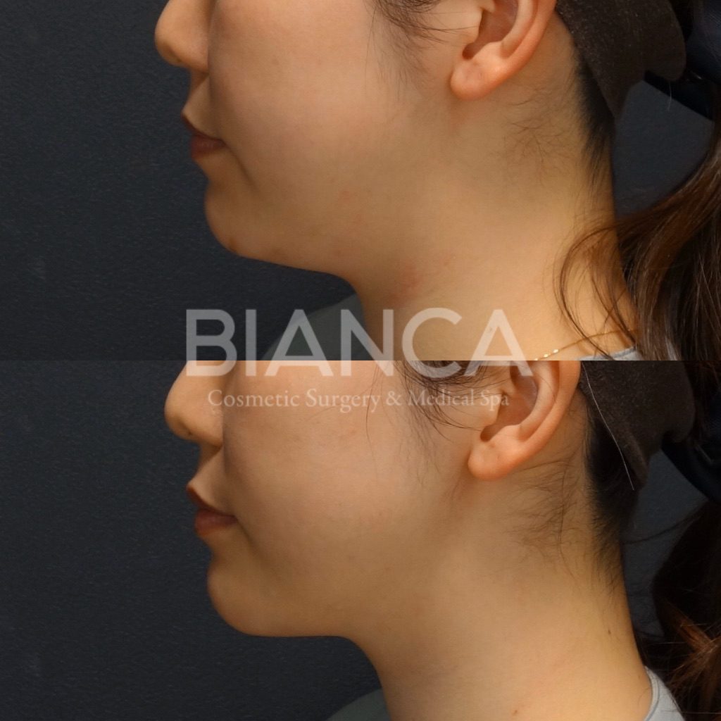 LIPO HIFU