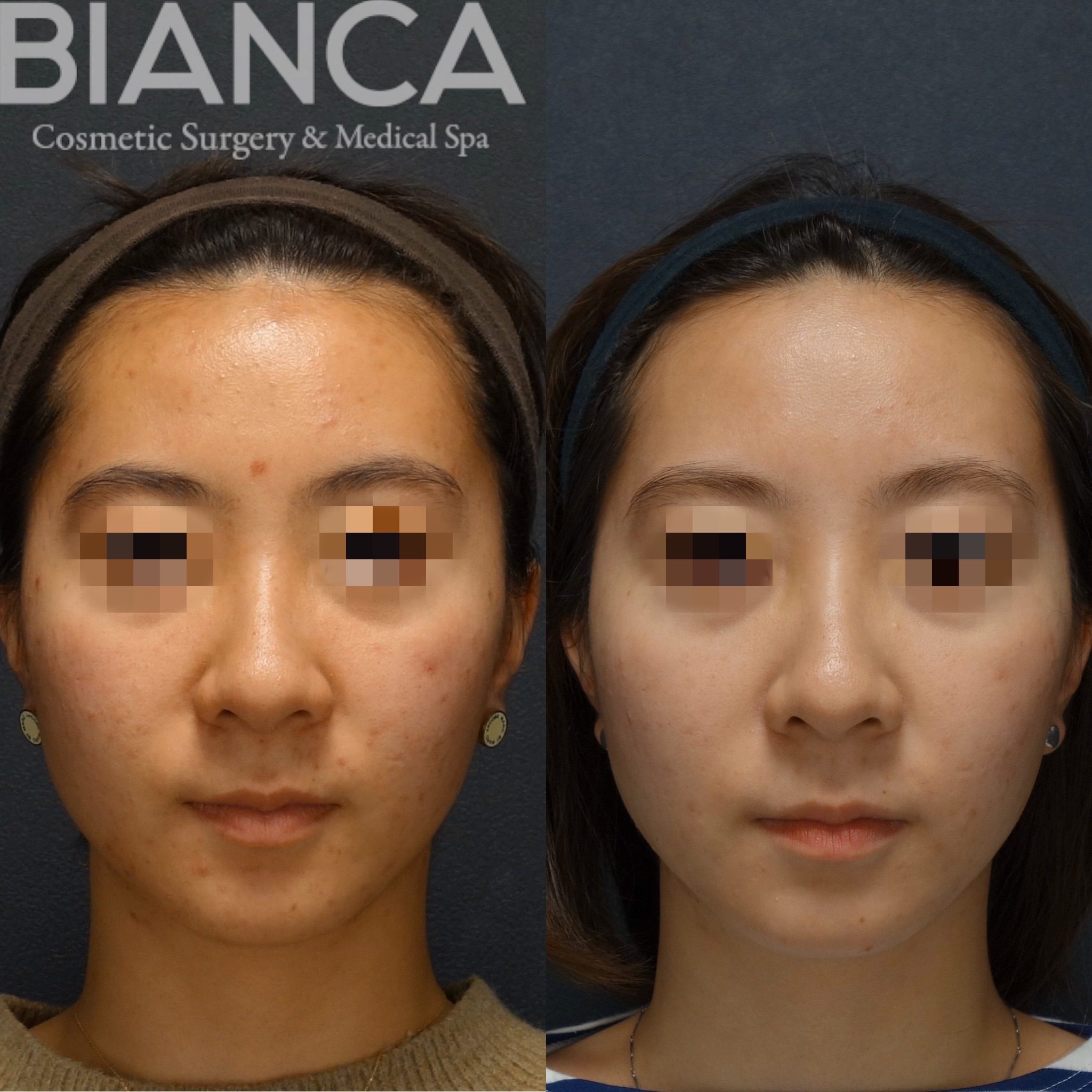 HydraFacial✖️Roaccutane