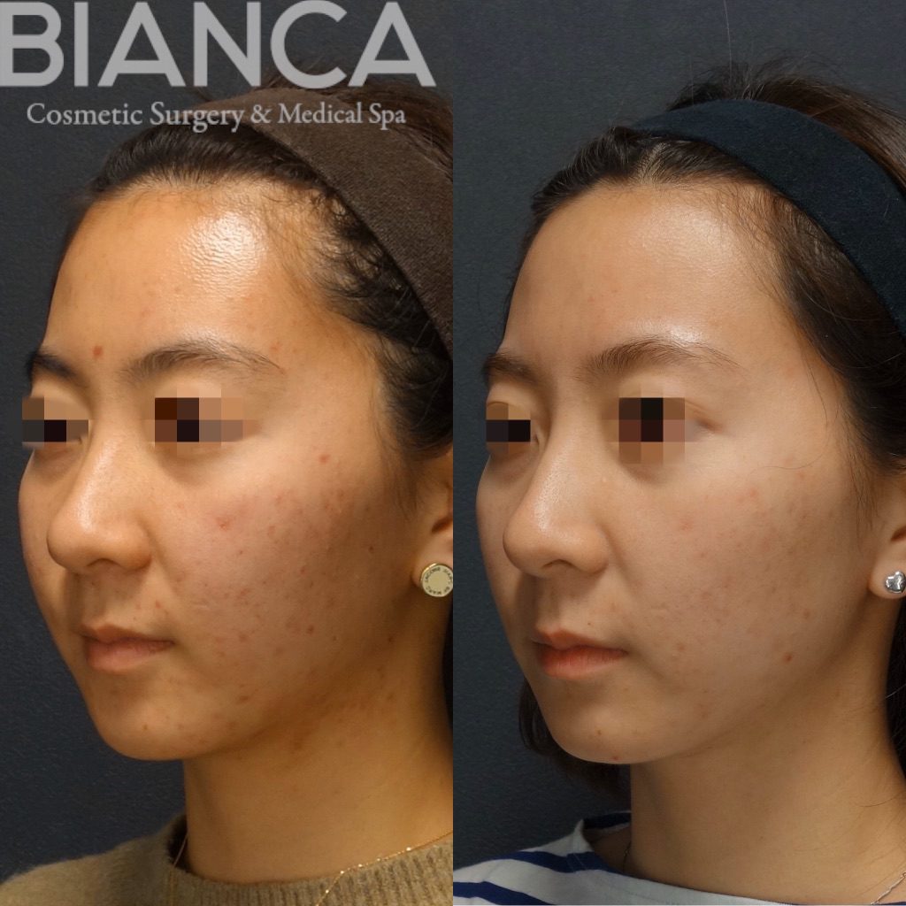HydraFacial×Roaccutane