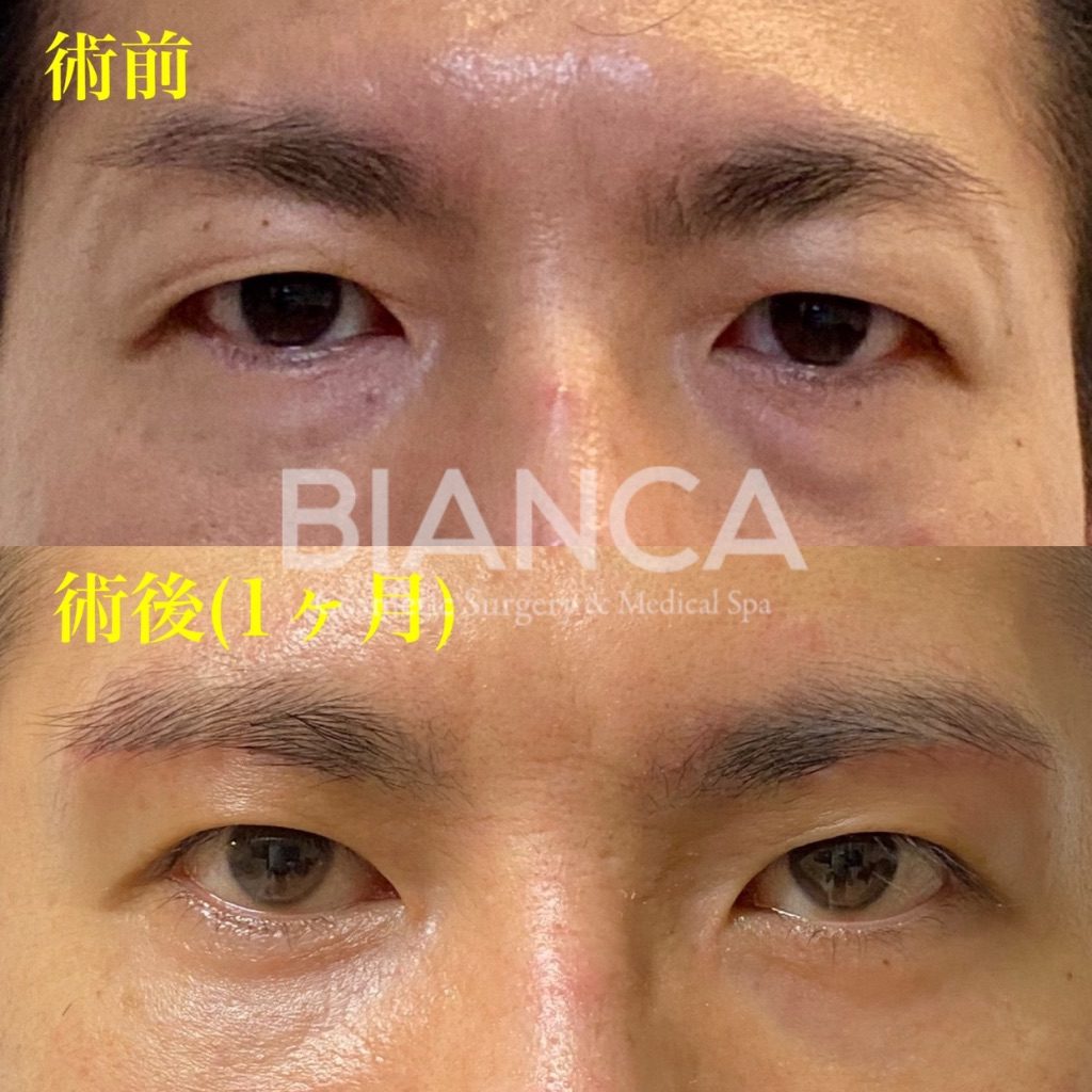 眉下切開✖️上瞼脂肪取り✖️目の下クマたるみ取り