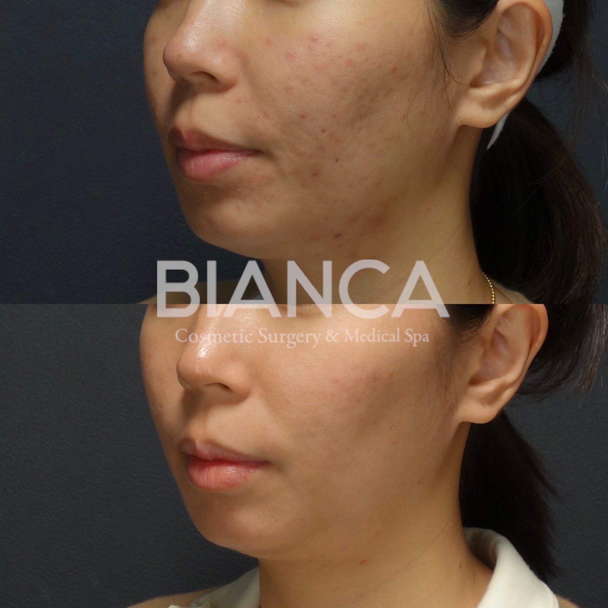 HydraFacial✖️Roaccutane