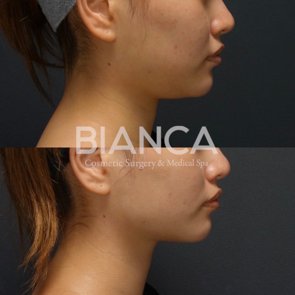 フェイスライン脂肪吸引✖️BIANCA LIFT