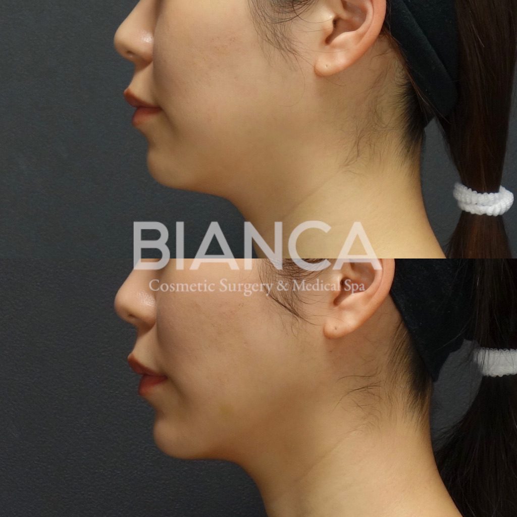 HIFUを超えるHIFU