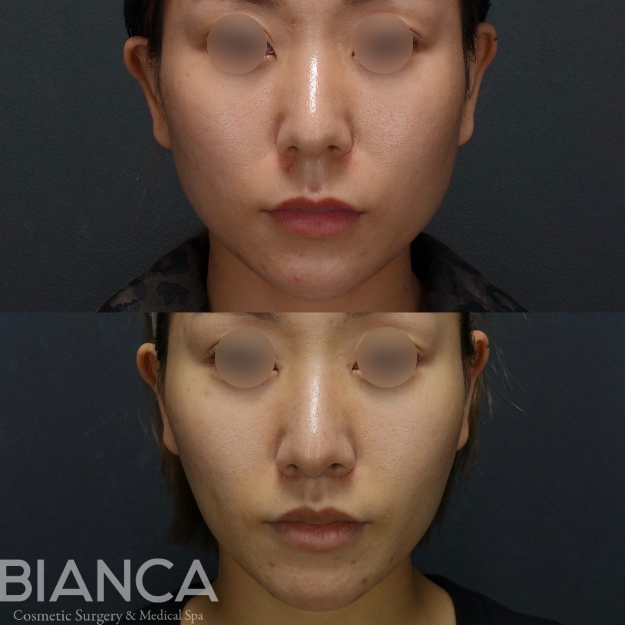 脂肪吸引✖️BIANCA LIFT✖️リップリフト