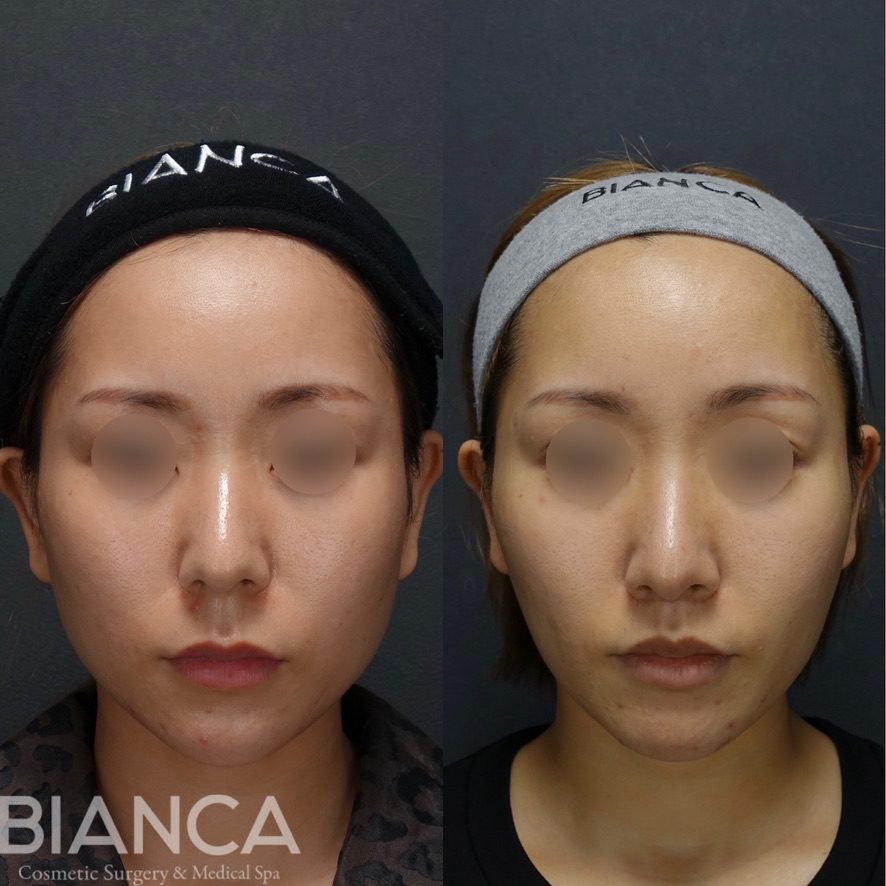 リップリフト✖️脂肪吸引✖️BIANCA LIFT