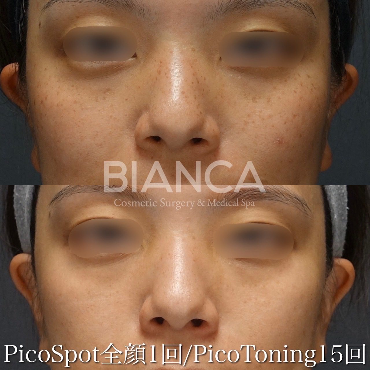 Pico Spot✖️ピコトーニング (PicoSure)