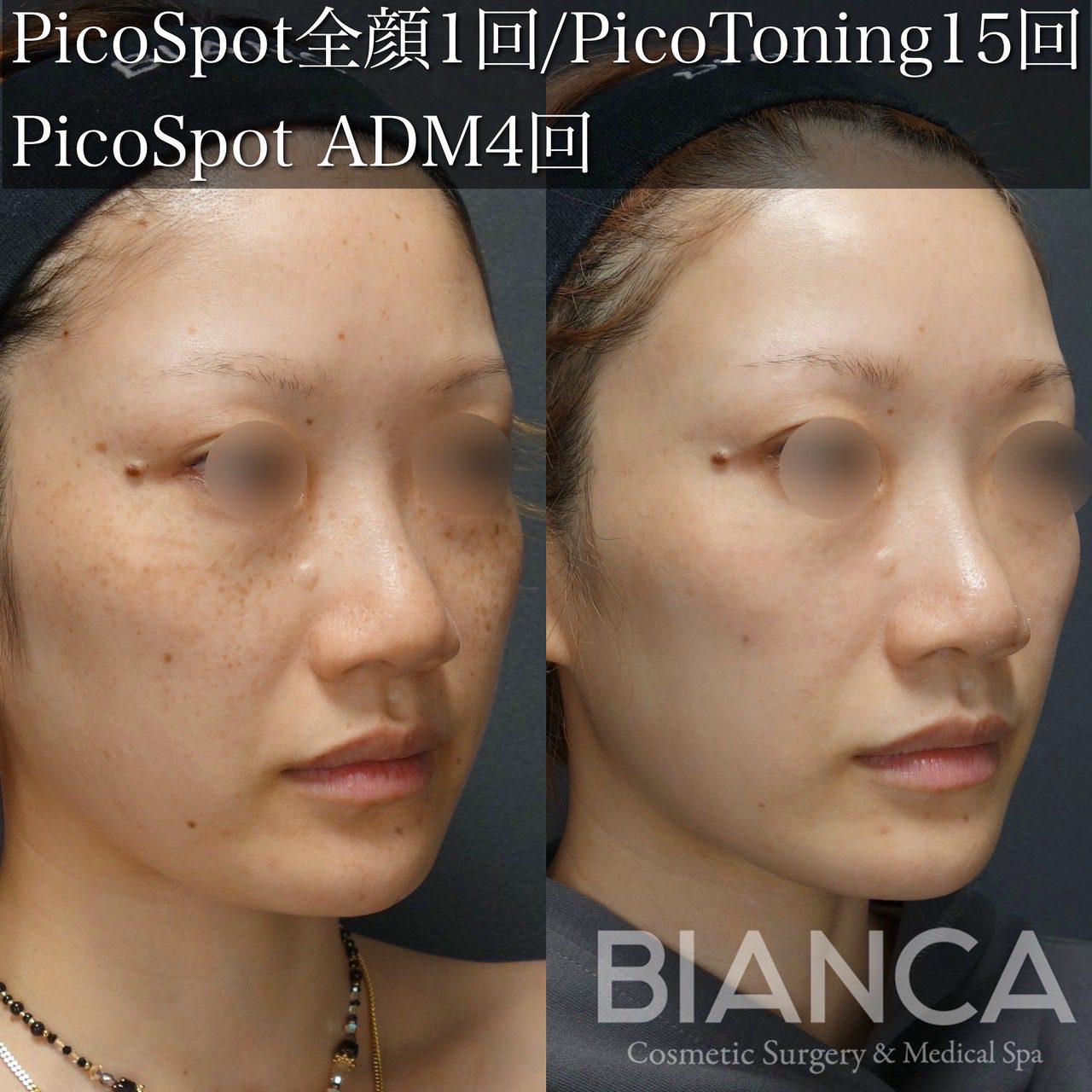 Pico Spot✖️ピコトーニング (PicoSure)