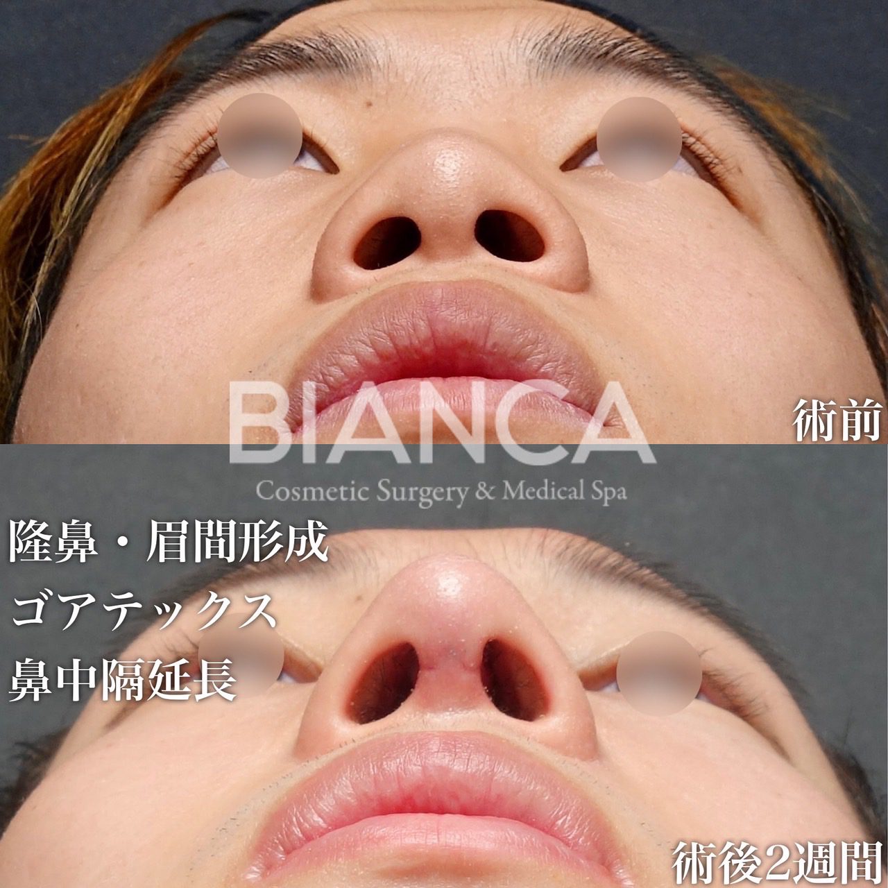 プロテーゼ✖️鼻中隔軟骨✖️耳介軟骨保存軟骨✖️鼻中隔延長