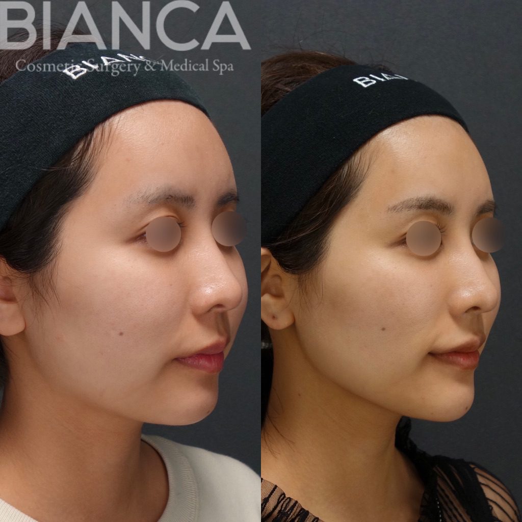フェイスライン脂肪吸引✖️メーラーファット ✖️バッカルファット ✖️BIANCA LIFT✖️VOLUX