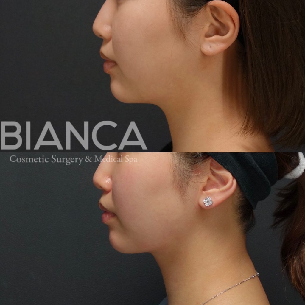 BIANCAの小顔治療