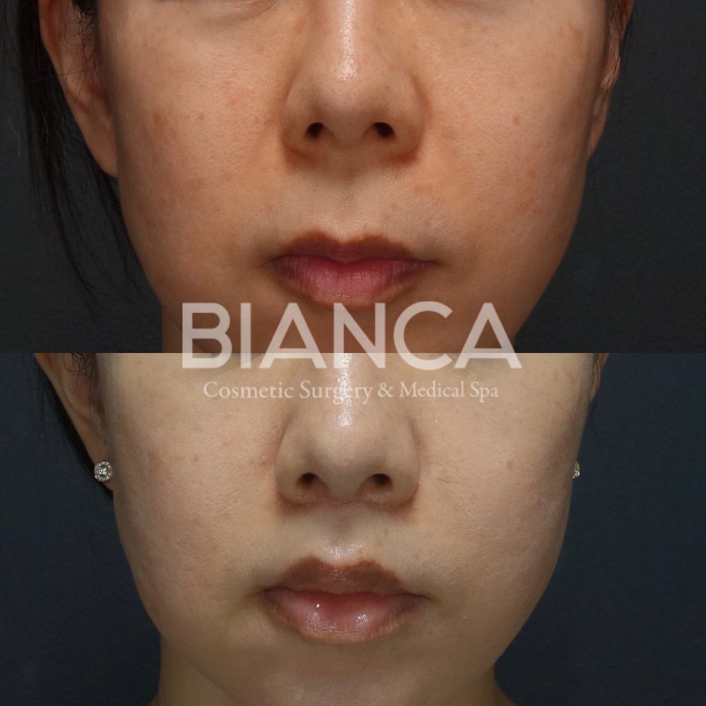 Lip Lift