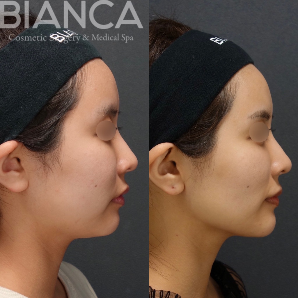 BIANCA LIFT・MINT LIFT・トータルフェイスサクション・メーラーファット除去・バッカルファット除去