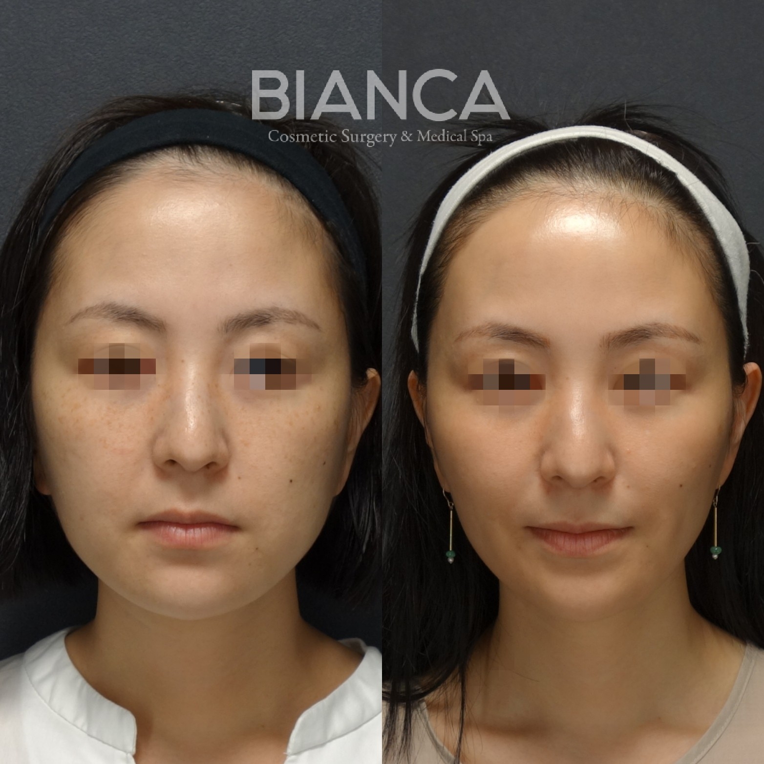 BIANCA LIFT