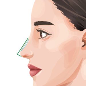 シリコンプロテーゼ（隆鼻術）銀座・表参道にあるBIANCA CLINIC ビアンカクリニック｜美容外科・美容皮膚科・再生医療・美容婦人科・美容内科・医療アートメイク