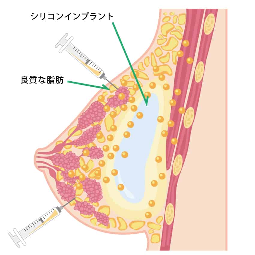 ハイブリッド豊胸（シリコンインプラント＋脂肪注入）