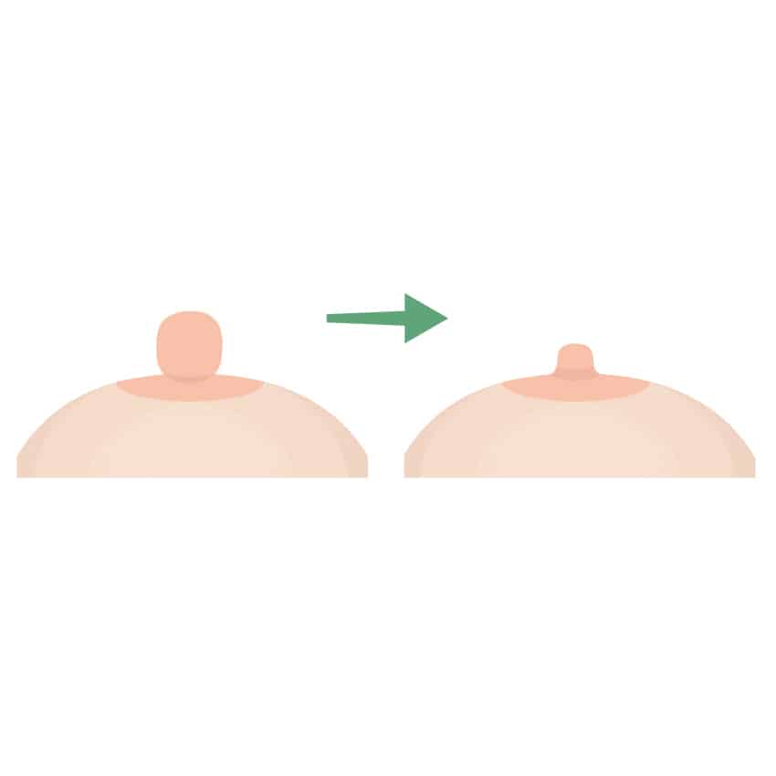 乳頭縮小