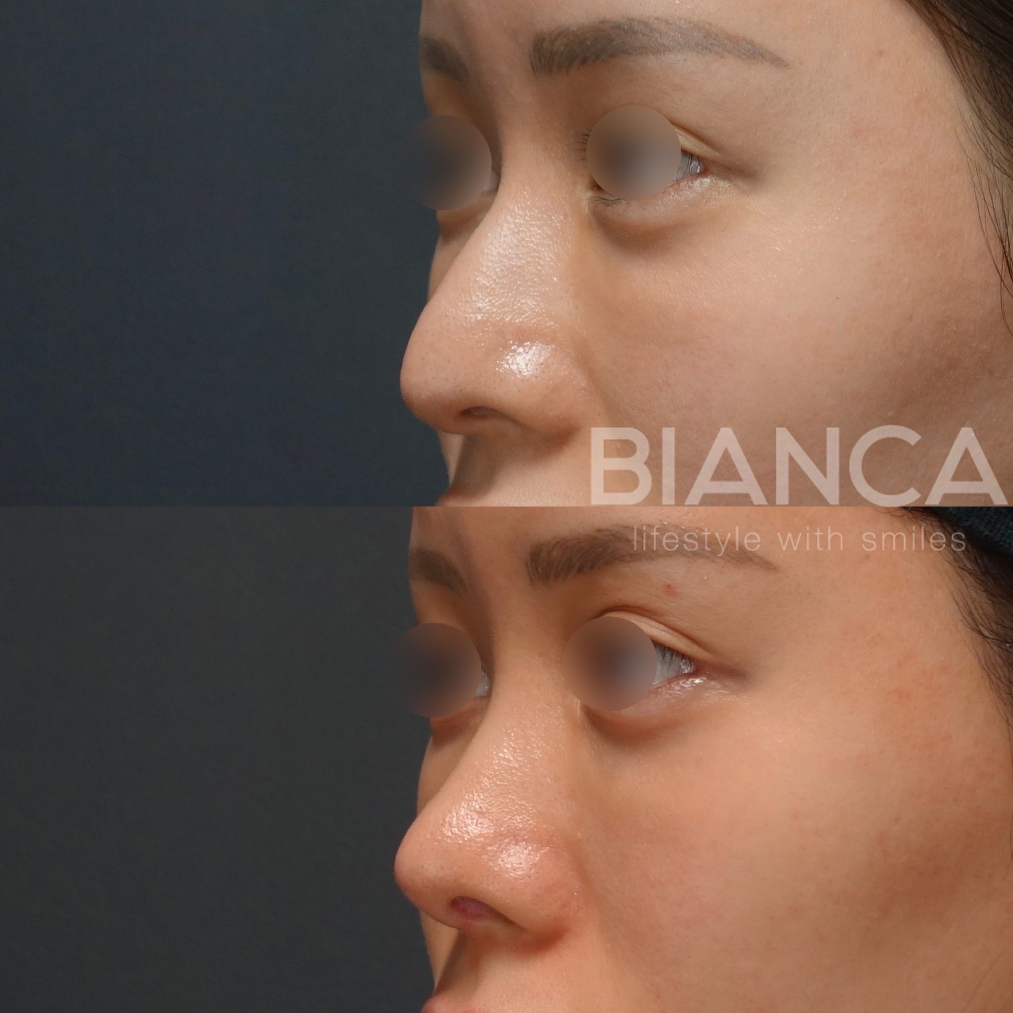 BIANCA RHINOPLASTY