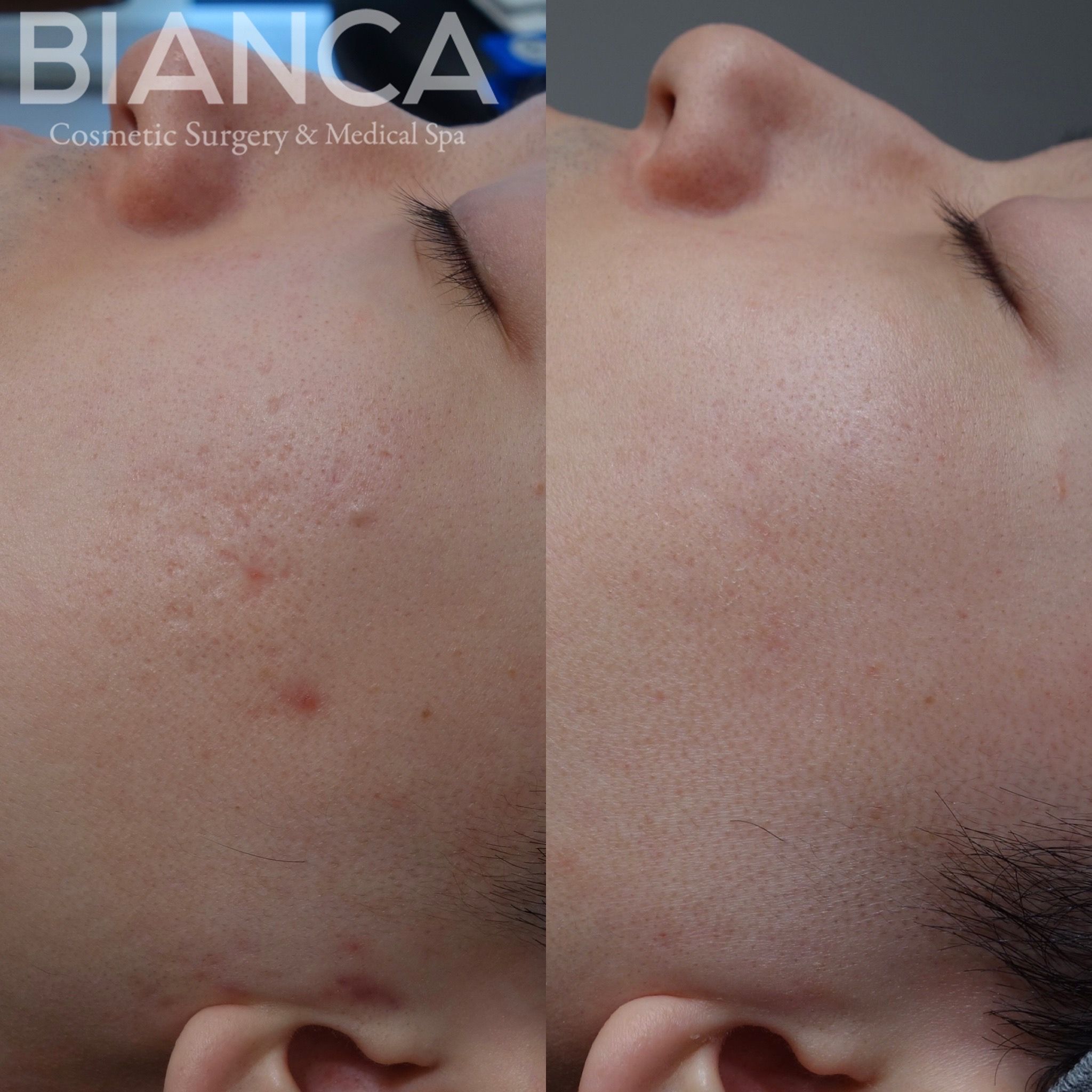 VampireFacial ✖️TCA CROSS