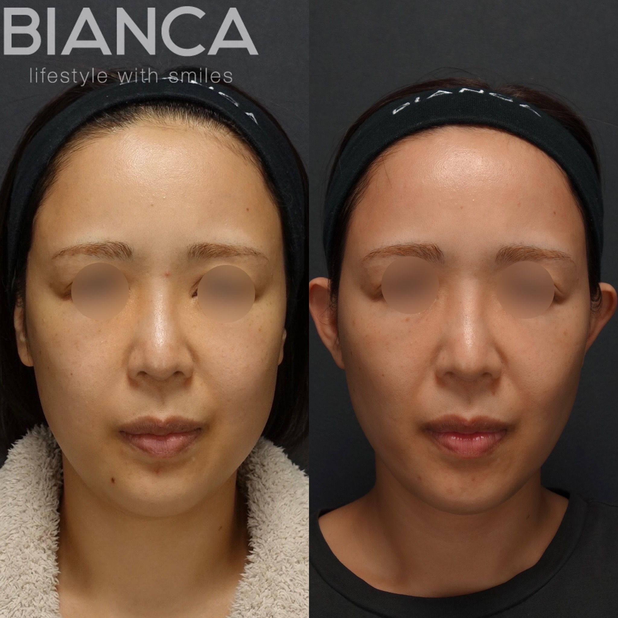 フェイスライン脂肪吸引✖️メーラーファット✖️バッカルファット✖️BIANCA LIFT