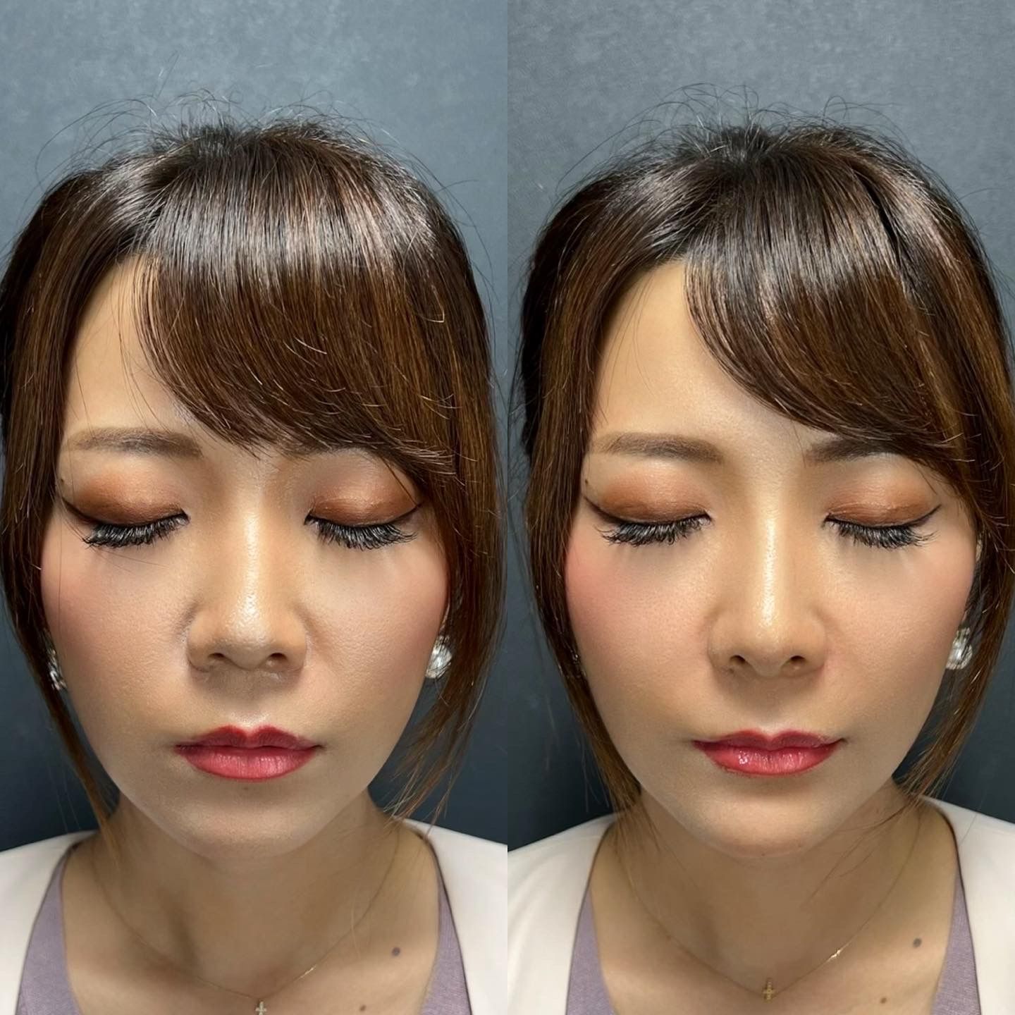 ヒアルロン酸（鼻、顎）