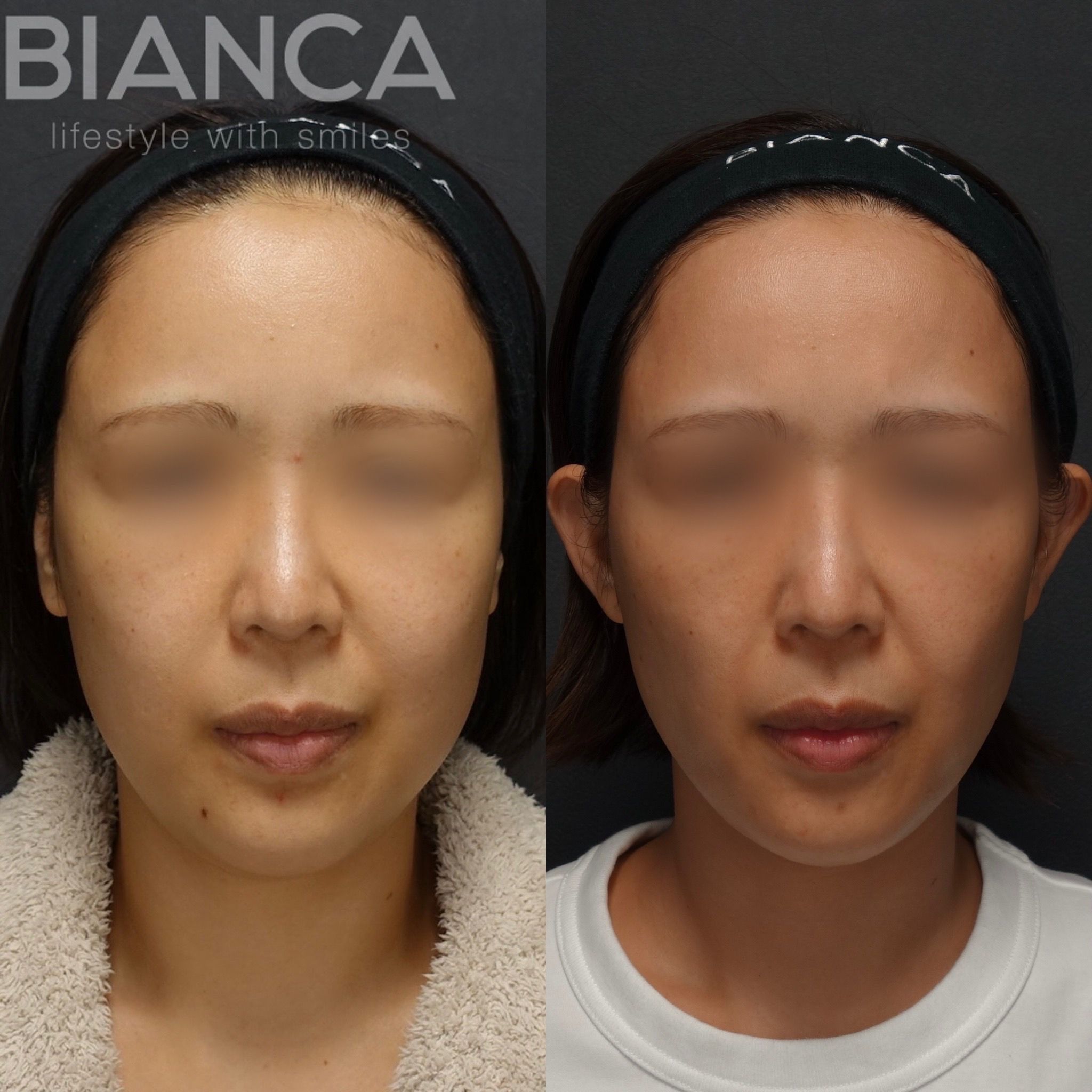 フェイスライン脂肪吸引✖️メーラーファット ✖️バッカルファット ✖️BIANCA LIFT