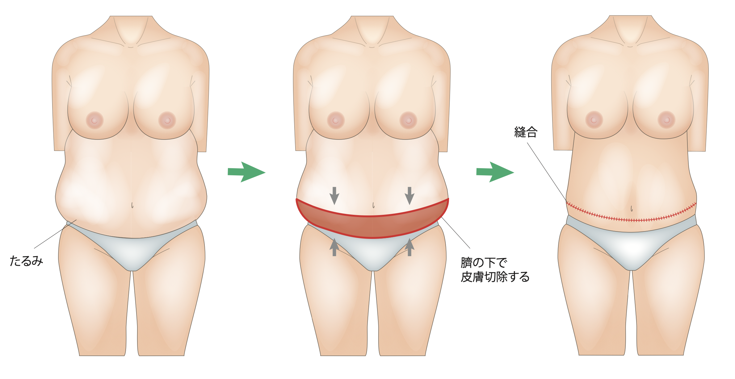 タミータック(腹部切除・臍形成)ビアンカ銀座｜日本を代表する美容健康再生医療のクリニック