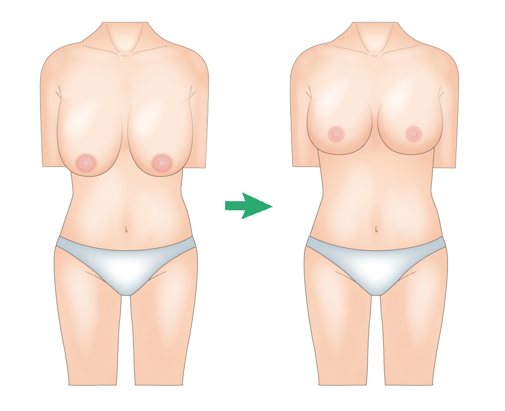 乳房縮小術