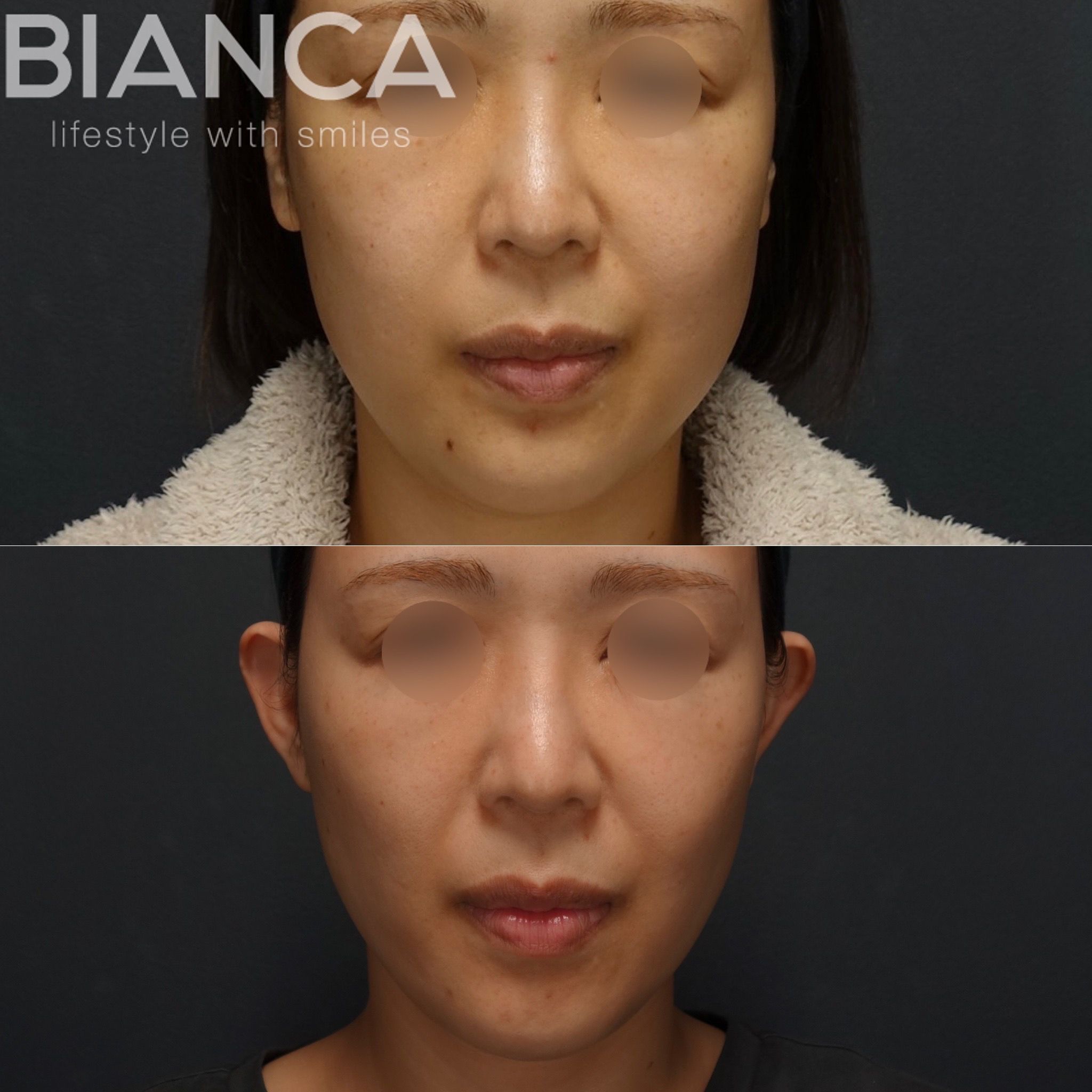 トータルフェイスサクション✖️バッカルファット✖️BIANCA LIFT