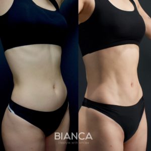 お腹の脂肪吸引に新時代!アブクラックス形成で自然な縦割れ腹筋を手に入れる【症例解説】 お腹の脂肪吸引 アブクラックス形成 術後3ヶ月