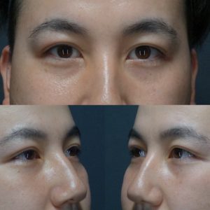 裏ハムラ二重埋没術後