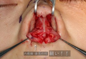 鼻修正