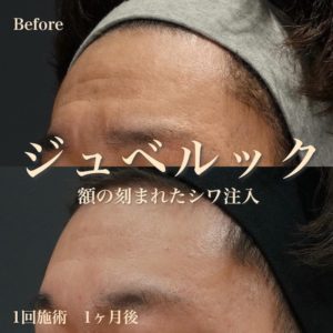 juvelook（ジュベルックs）によるシワ治療の症例