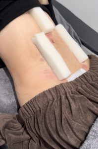 アブクラックス形成（脂肪吸引）　術後３日目
