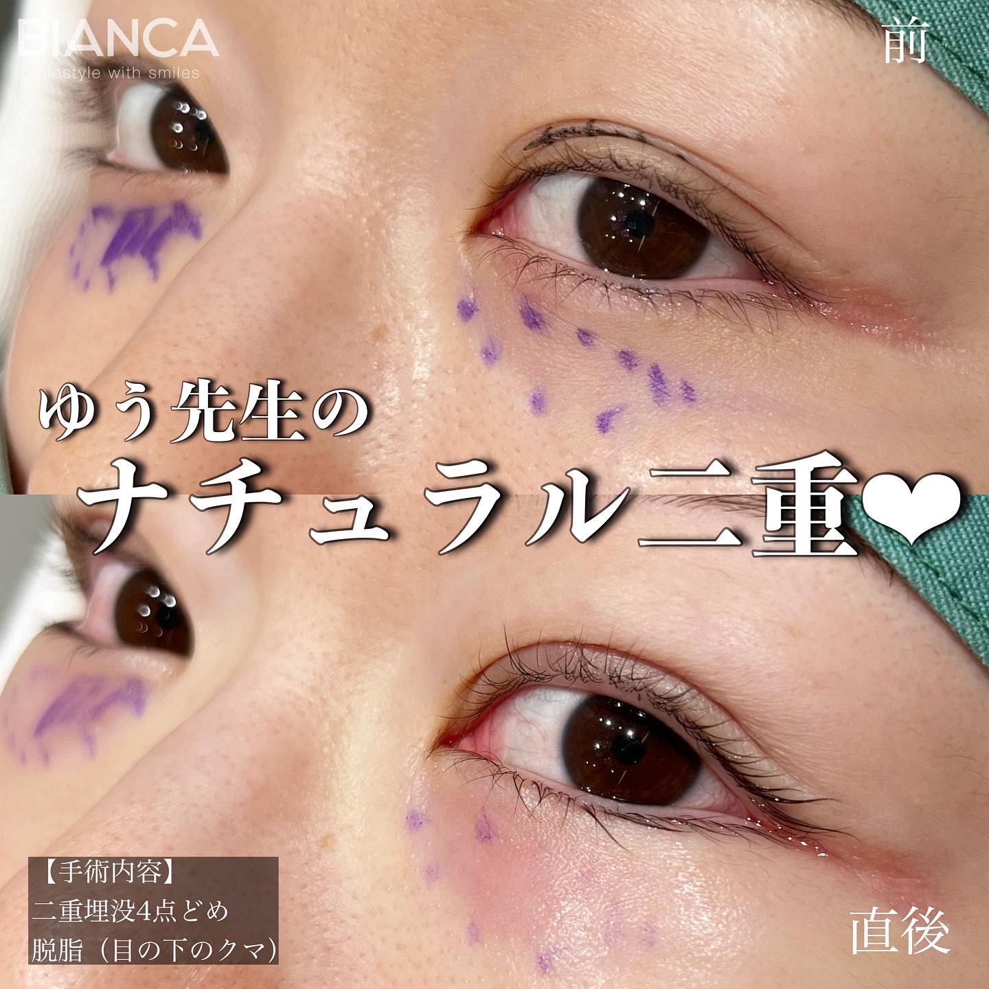 グラマラス形成✖︎脱脂